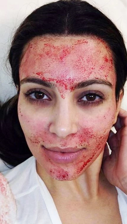 Το Vampire Facial της Kim Kardashian (1.320€/θεραπεία)