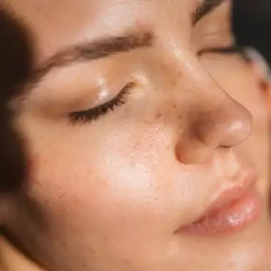 Πανάδες | Πώς θα ξαναβρείτε την καθαρή, λαμπερή σας επιδερμίδα